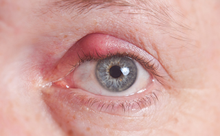Blepharitis on the eye