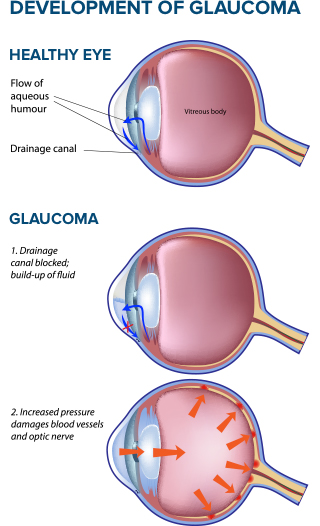 Glaucoma Vs Healthy Eye Diagram 