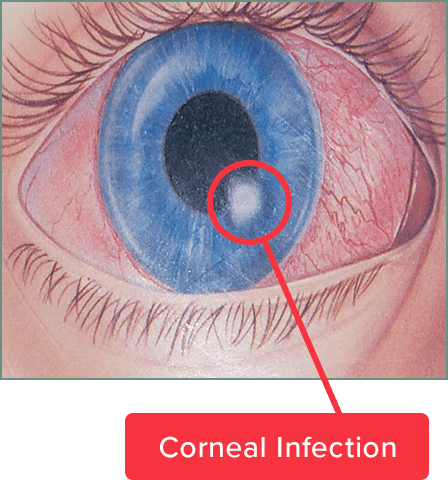 red eye from corneal infection 