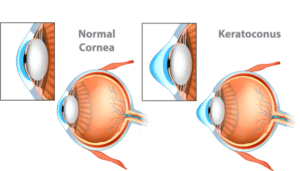 normal cornea vs keratoconus