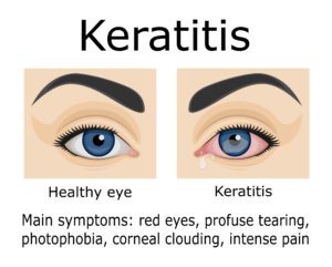 bacterial keratitis