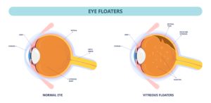 retinal eye floaters