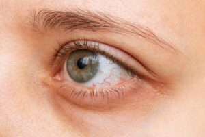 Getting Hit In The Eye