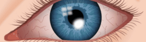 Corneal Infection